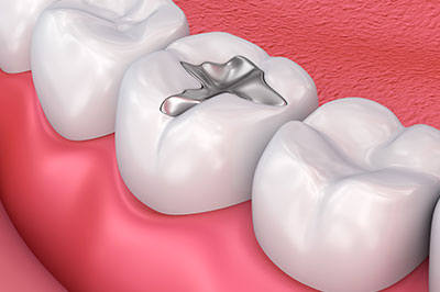 The image shows a close-up of a dental implant being inserted into a prepared tooth socket, with the surrounding teeth and gums visible.