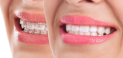 The image shows a close-up of a person s face with a focus on their teeth, which are being highlighted by a bright pink lipstick.