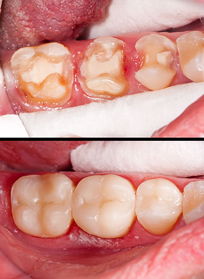 The image displays a close-up of an open mouth with teeth showing signs of decay and gum disease, and there is a before-and-after comparison of the same mouth after dental treatment.