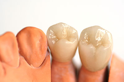 An image showcasing a set of artificial teeth, including upper and lower dentures, with one side featuring a natural-looking tooth and the other a red-toned resin material.