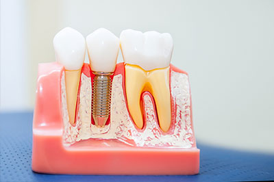 The image shows a close-up of a dental model with a toothpick inserted into the gum line, featuring multiple teeth and gums, with a focus on a small screw or pin in one area.