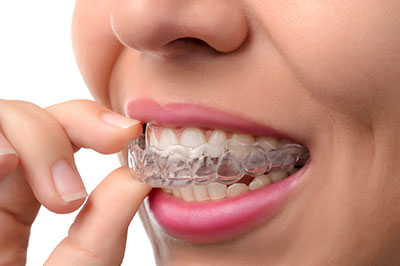 An adult woman with a clear orthodontic aligner in her mouth, holding it between her fingers.