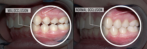 The image shows a side-by-side comparison of two dental procedures, one with a normal occlusion and the other with malocclusion.