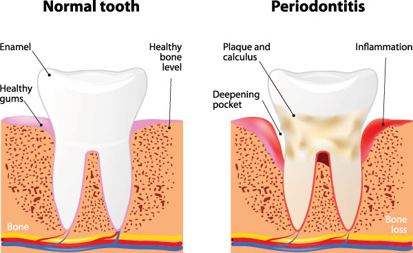 The image shows a diagrammatic representation of the progression of gum disease, from normal teeth to advanced periodontitis. It illustrates how healthy bone and tissue are affected as gum disease advances, with labels indicating different stages of the condition.