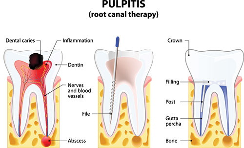 The image displays a diagrammatic representation of the pulpitis process in teeth, showing the progression from dental caries to inflammation and infection within the tooth pulp.