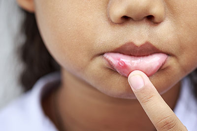 The image depicts a young child with acne on their face, holding a finger to their lips as if contemplating or examining the skin condition.