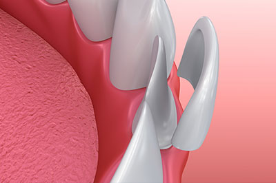 The image shows a close-up of a dental implant with a metal screw and a pink abutment, likely for educational or promotional purposes.