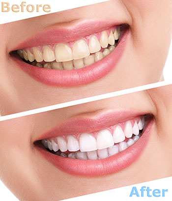 Before and after teeth whitening image showcasing a dramatic improvement in tooth color.