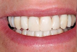 A close-up of a person s smile showcasing straight, white teeth.