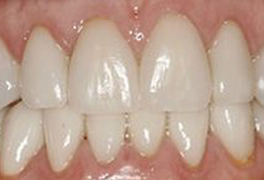 An image of a person s mouth showing a set of teeth with visible staining and yellowing, suggesting the need for dental care or maintenance.