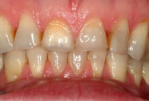 An image of a person s mouth displaying a set of crooked, yellowed teeth with visible plaque and stains.